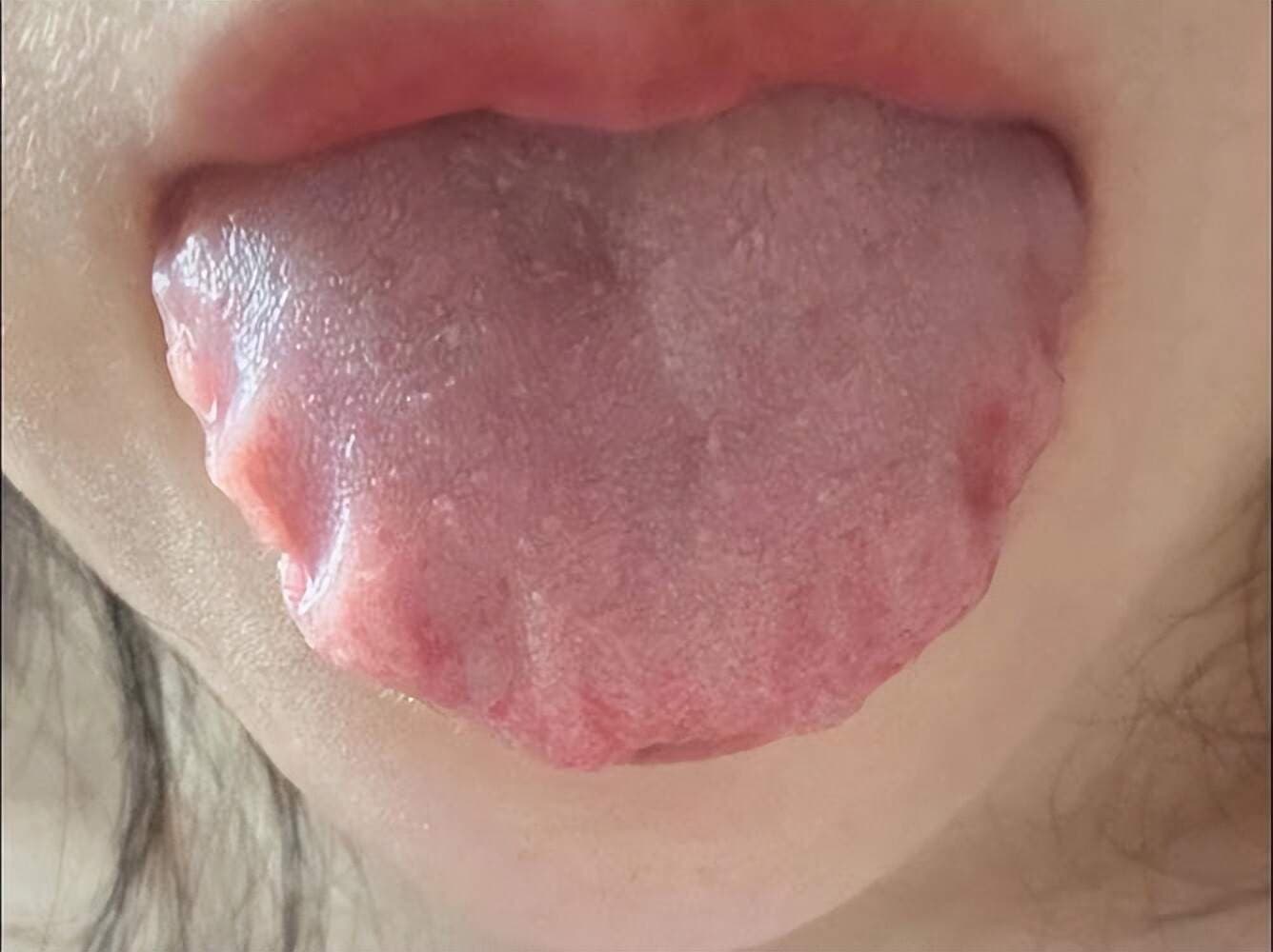 舌头裂纹和齿痕？保温杯里加点料，健脾利湿，养阴生津！