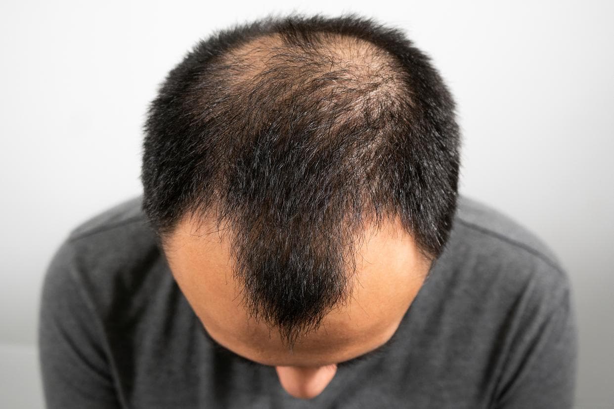 中医学上是如何看待脂溢性脱发的