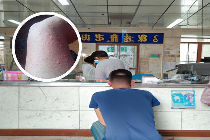 荨麻疹请假可以请多久？医生给出专业建议
