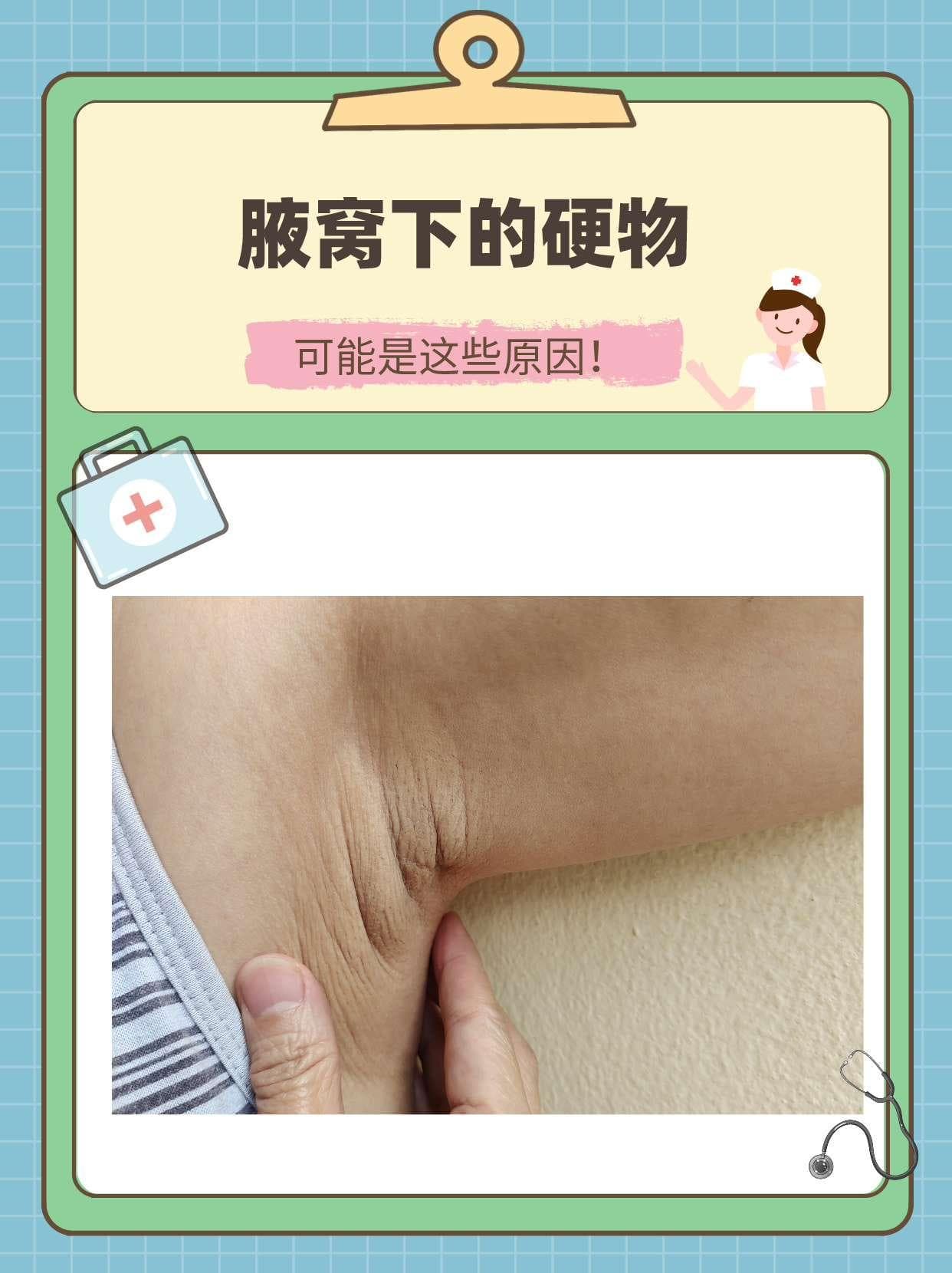 腋窝下的硬物，可能是这些原因！