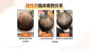 一直掉头发很严重怎么办