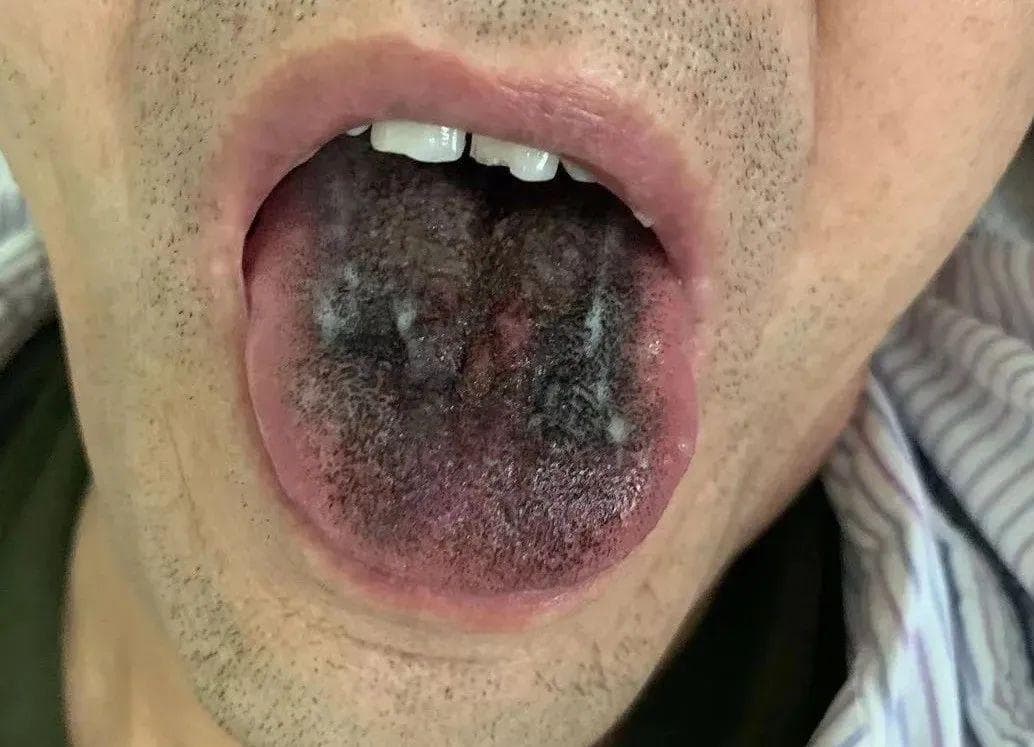 舌头变黑、毛茸茸？原因是......