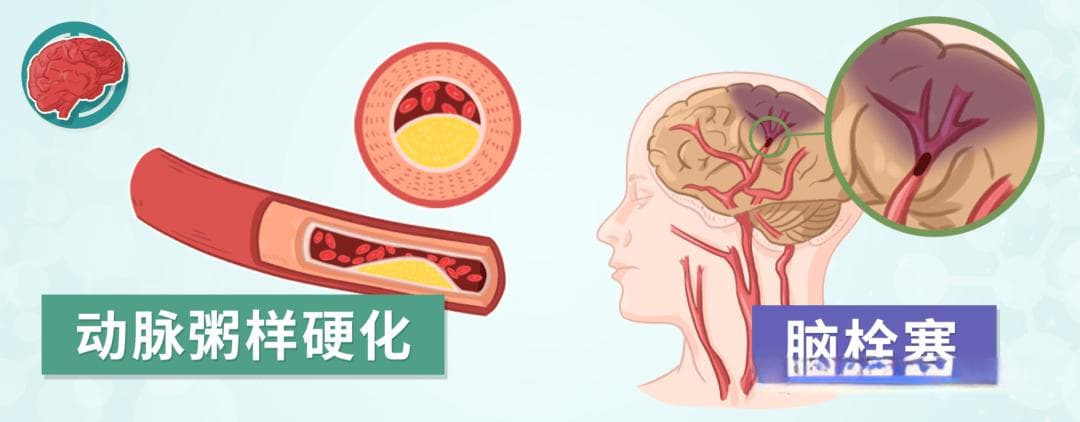 引起脑梗死的原因有哪些？出现偏瘫、肢体麻木、讲话不清等症状，会是脑梗死吗？