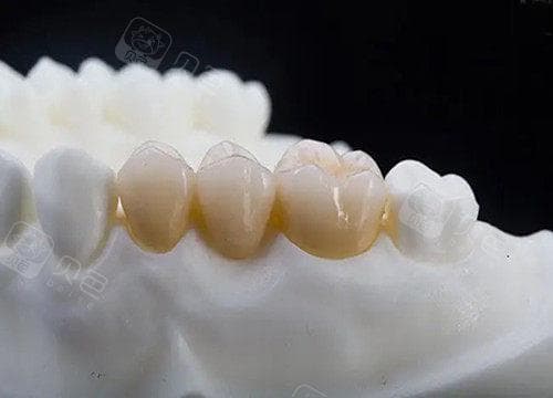 固定义齿与活动义齿哪个好？各有各的优缺点，详细进来看看