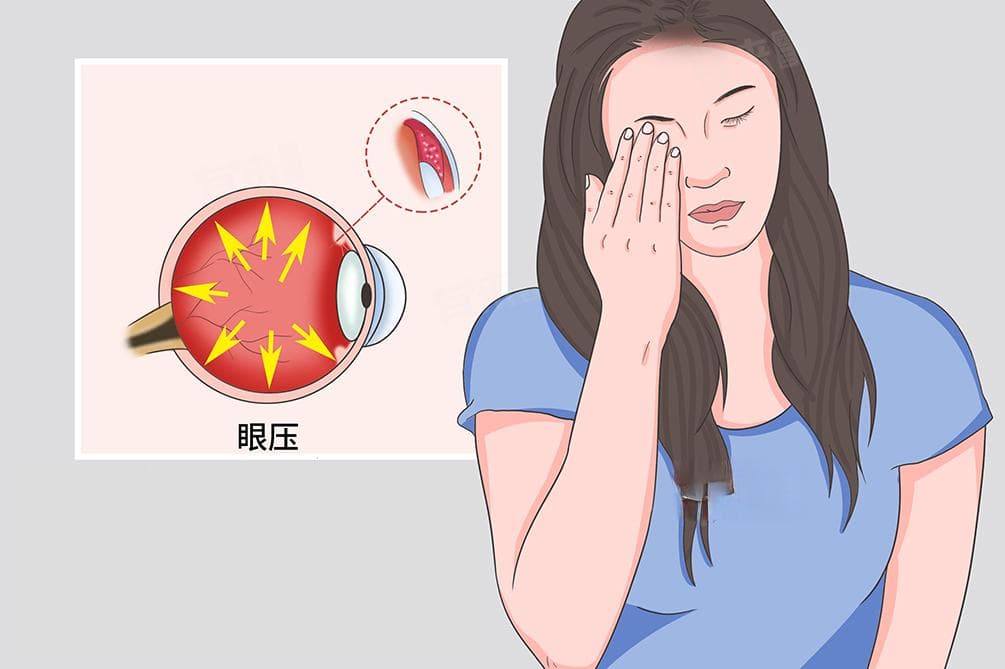 急性闭角型青光眼的治疗方法