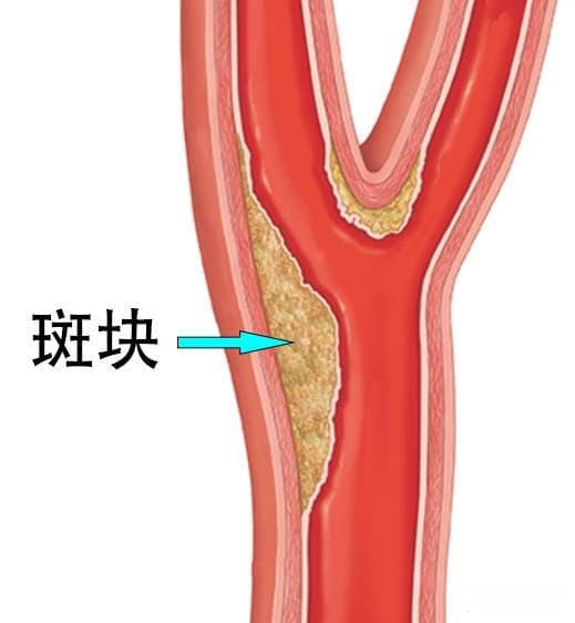 关于颈动脉斑块，你需要知道的十件事