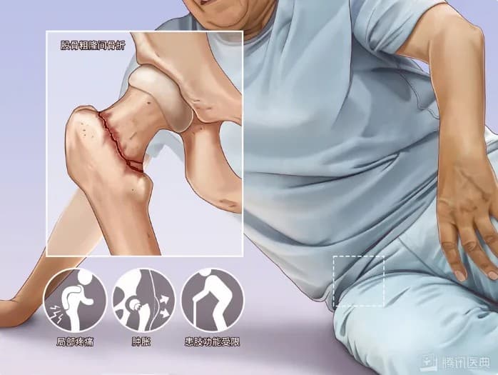 这个骨折致死率高达40%，高龄也能进行手术治疗