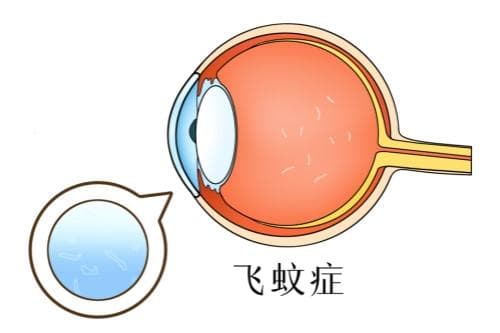 全飞秒术后飞蚊症怎么办？全飞秒后飞蚊症症状会慢慢好吗?