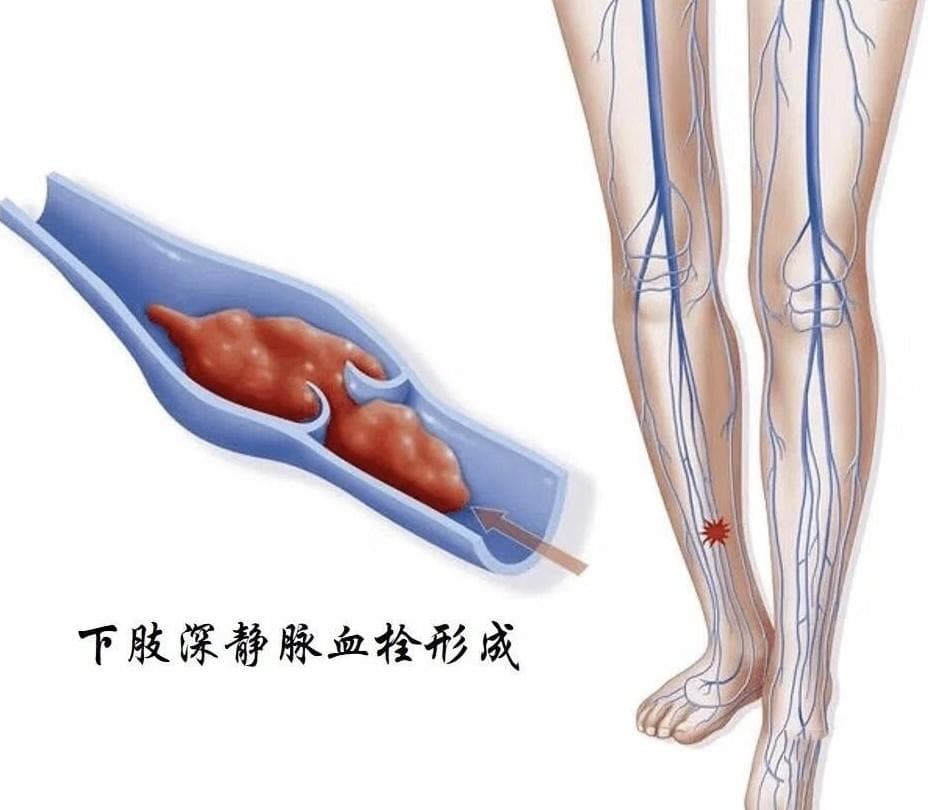 年轻女子腿部肿痛，罪魁祸首竟是“抗磷脂综合征”