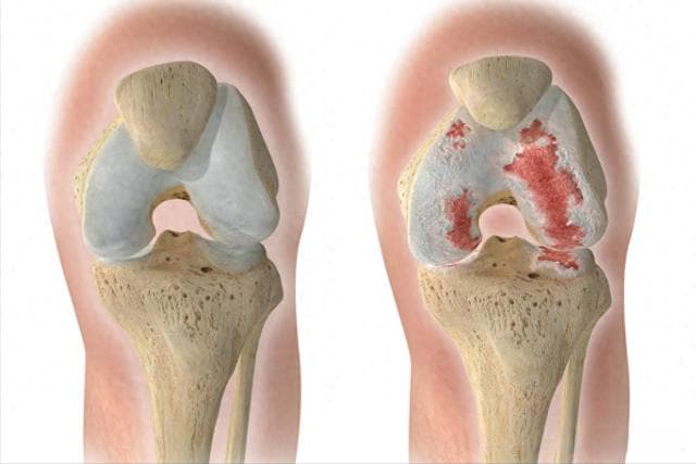 什么是膝骨关节炎？医生介绍病因、症状、诊断和治疗四个方面