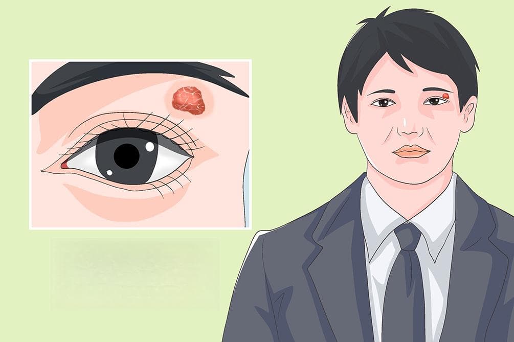 眼眶炎性假瘤