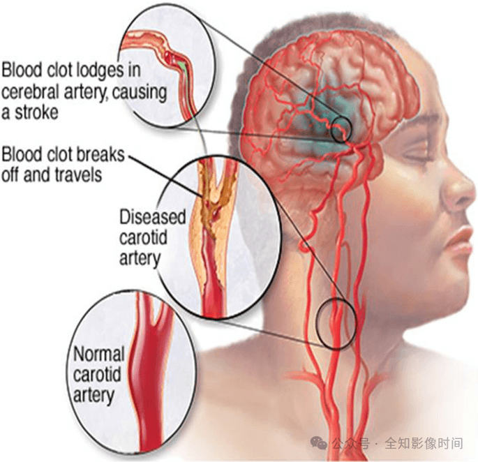 脑部磁共振成像（MRI）常见诊断描述及含义