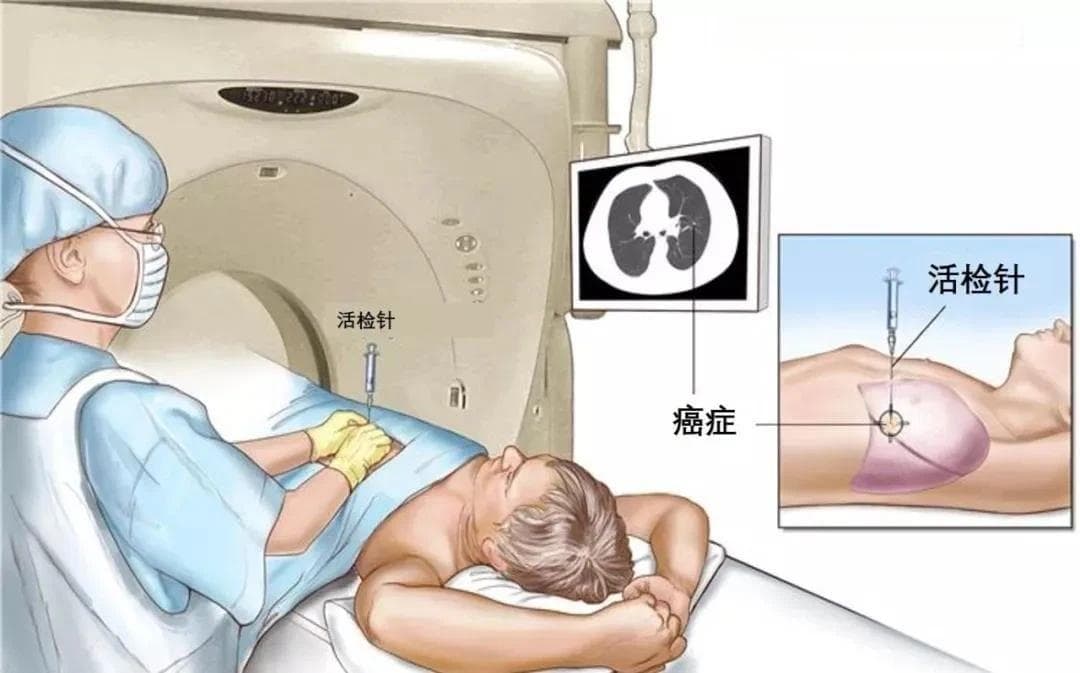 肺穿刺护理小贴士
