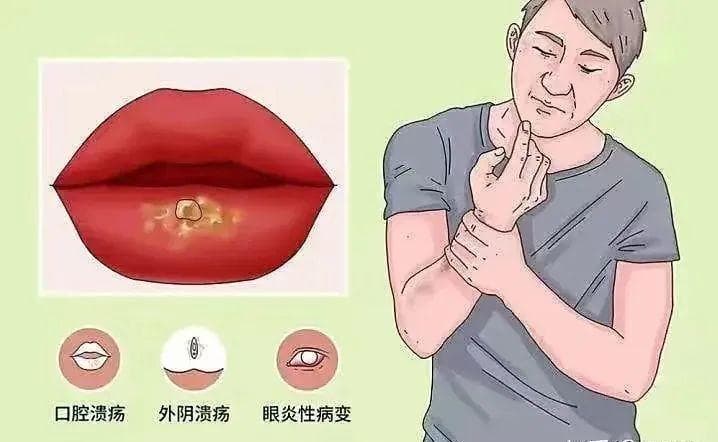 白塞氏病：一种慢性全身性血管炎症性疾病