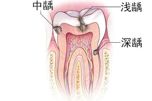 龋齿补牙多少钱一颗？浅龋/中龋/深龋修复价格都有不同