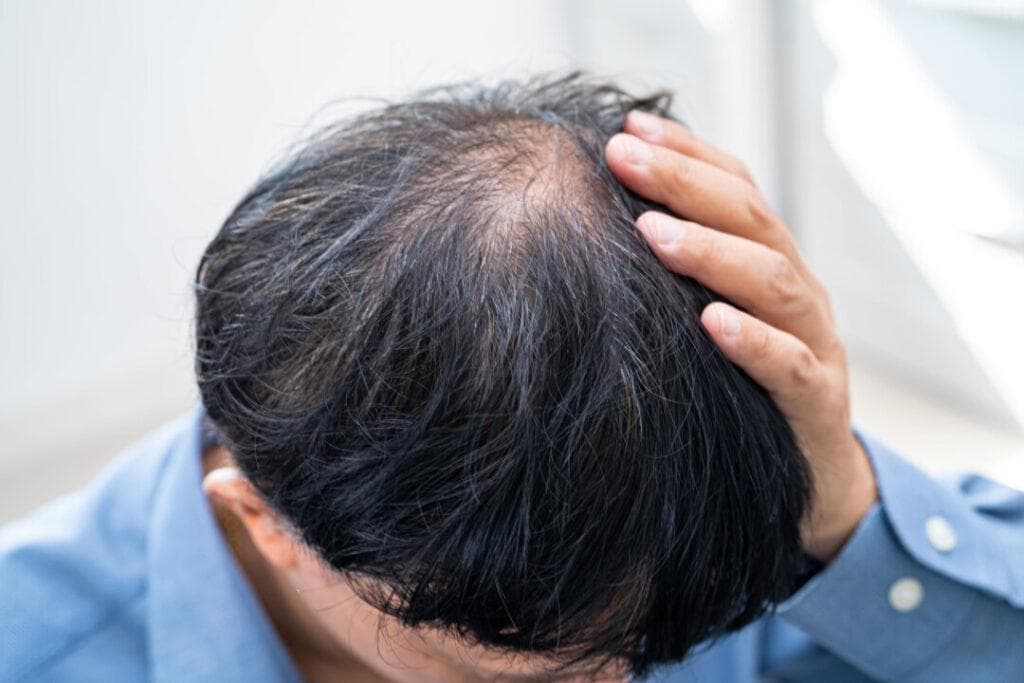 5招告别「注定秃头」！中西医结合智慧 从根源改善雄性脱发