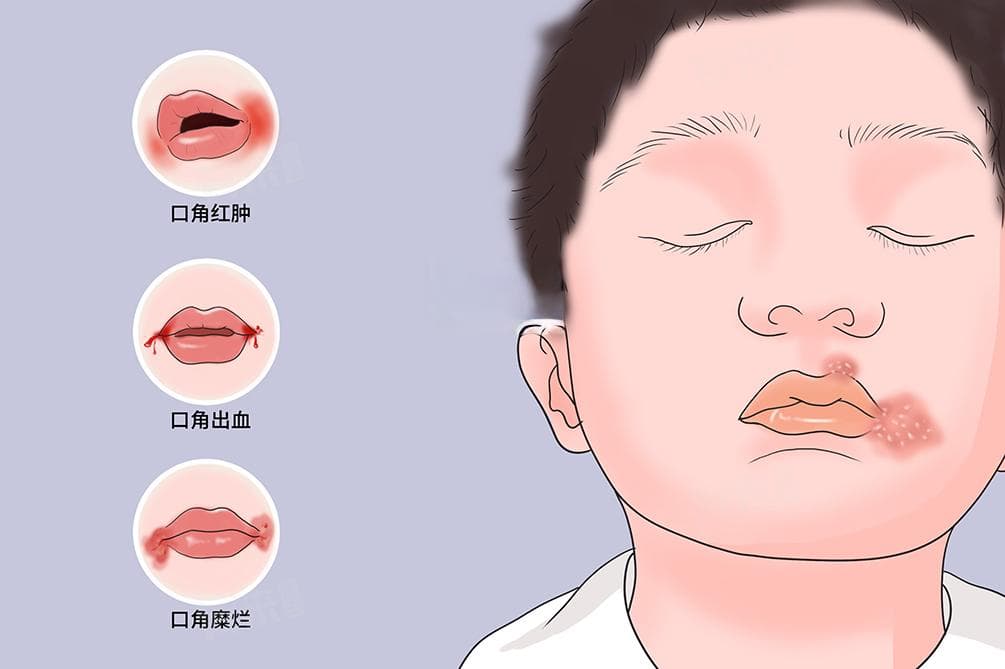 口角生疮最快治疗方法