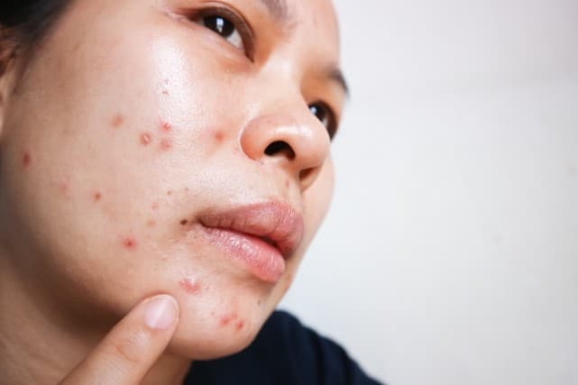 吃抗生素治疗痤疮，安全吗？专家给出了这样的回答，其中这2点最关键
