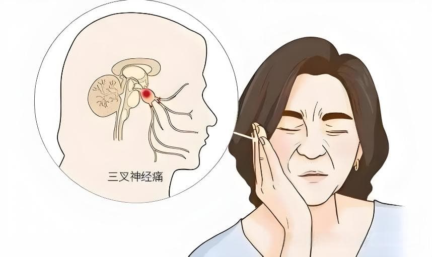 天下第一痛：三叉神经痛