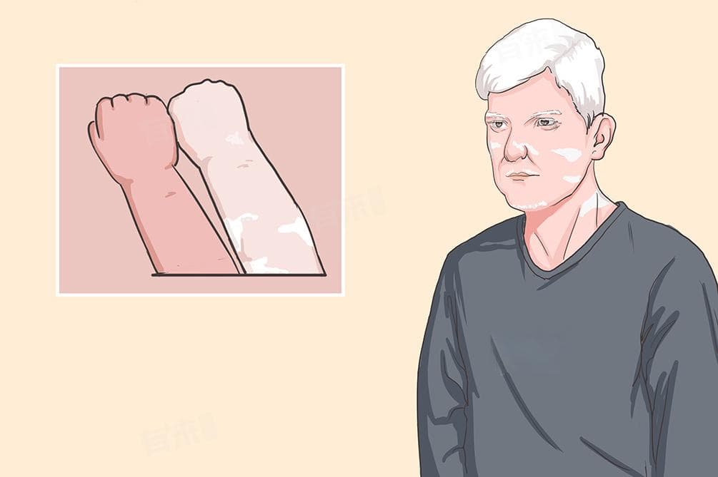 白化病人一般能活多久