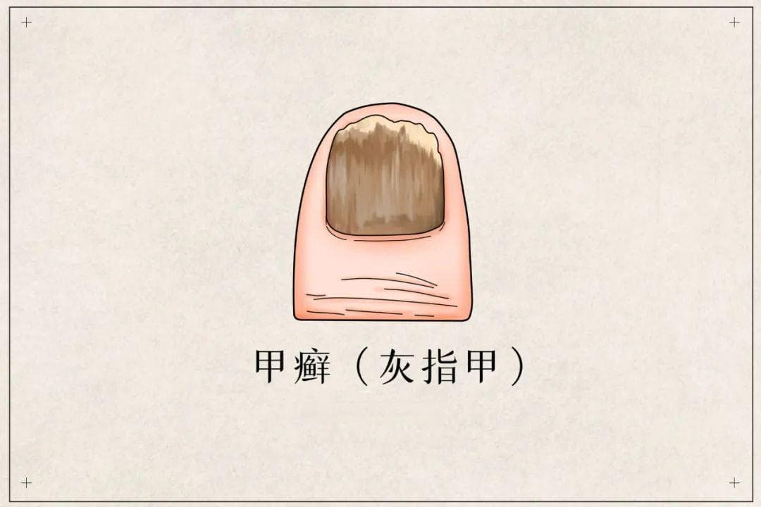 看指甲辨健康，指甲长成这2种样子，不是大病就是癌症!