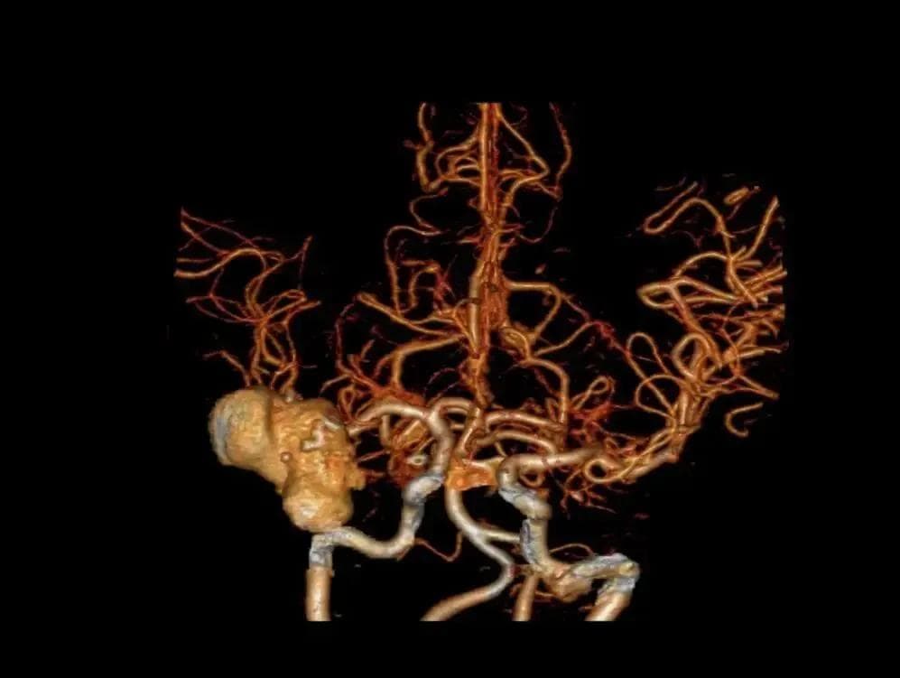 一文读懂：CT、核磁共振、脑血管造影有何不同？