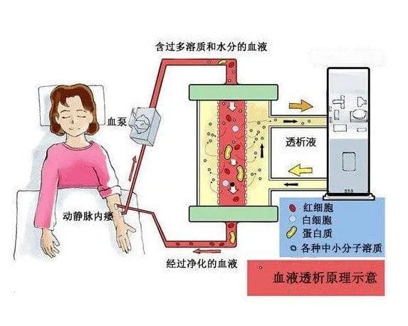 透析过程中出现低血糖，终末期糖尿病肾病血液透析患者血糖如何管理？