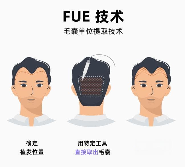 科普解颐丨头皮“精装修”之植发那些事儿