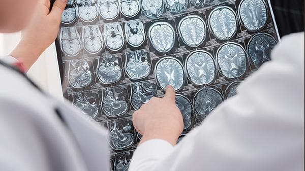 脑钠肽的临床意义是什么？正常值是多少？