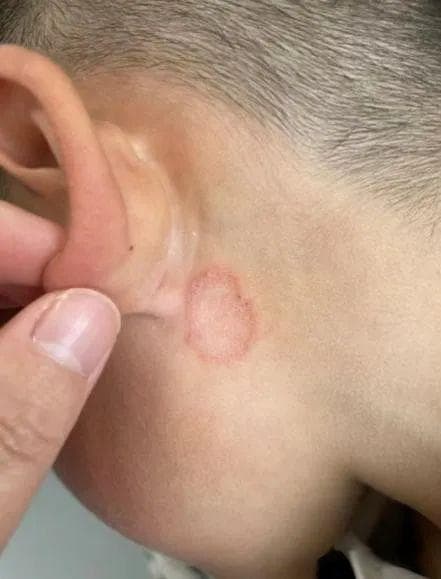 离心性环状红斑是怎么回事？