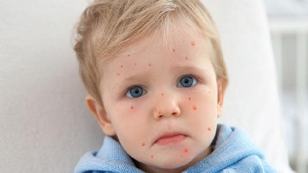 油痘肌救星！理肤泉、薇姿、雅漾水乳全解析