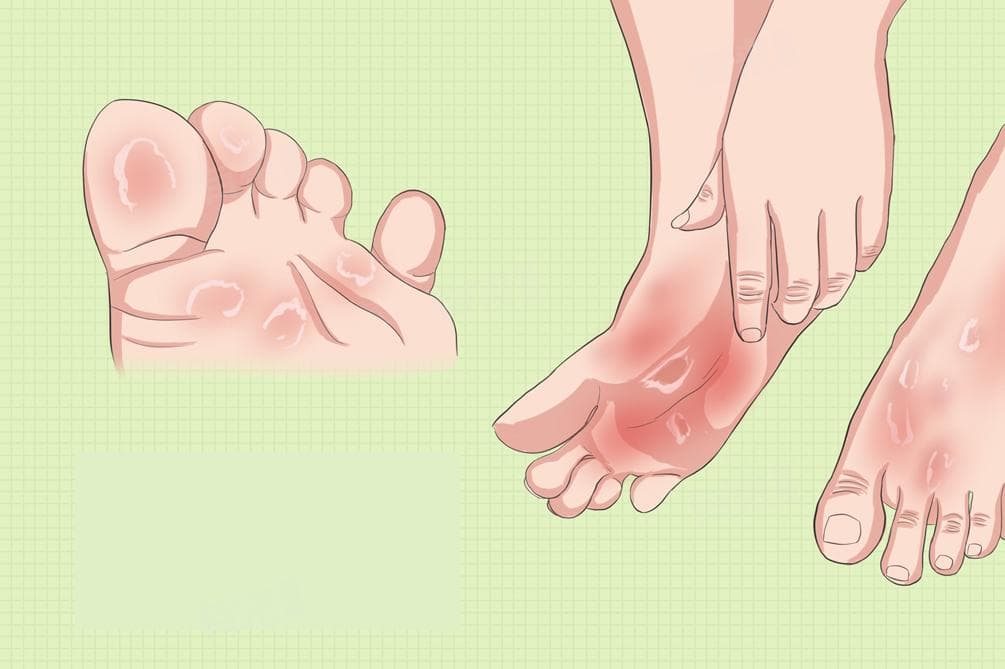 脚气的六大症状及预防方法
