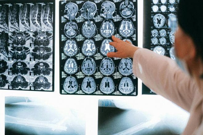 脑血管病、脑梗死、中风、卒中，如何正确识别？