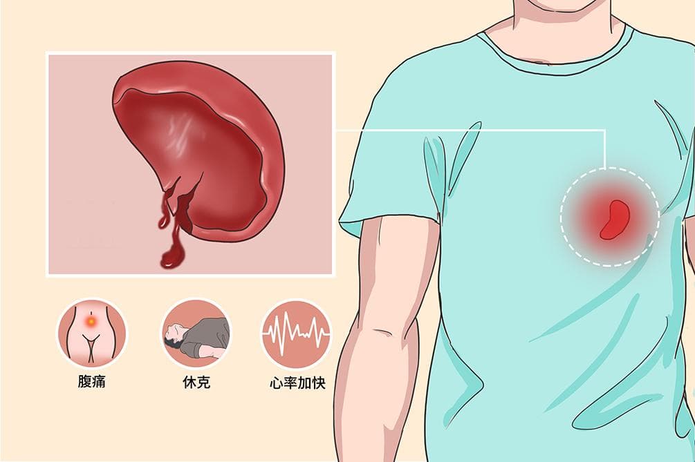脾破裂：病因、症状、诊断与治疗全解析