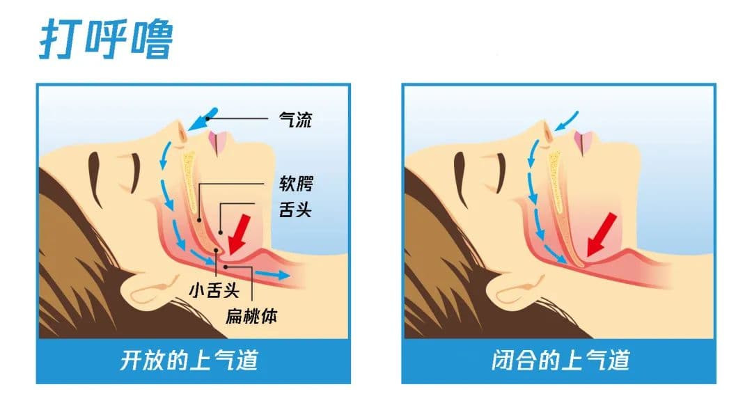 打呼噜不是小毛病，2个办法让呼噜“消失”