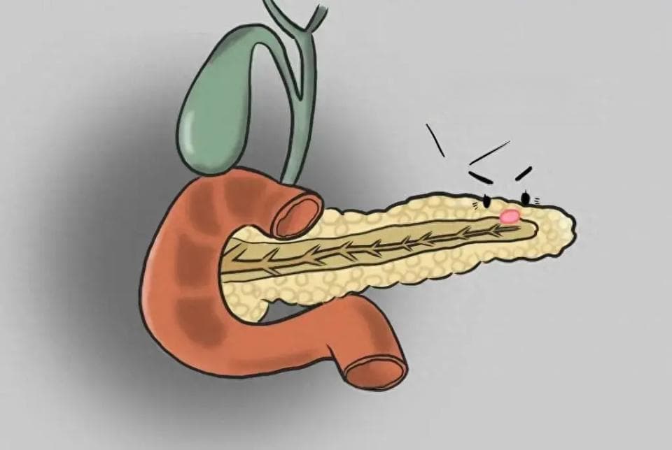 小心急性胰腺炎！医生提醒：9个症状不要忽视，严重可能危及生命