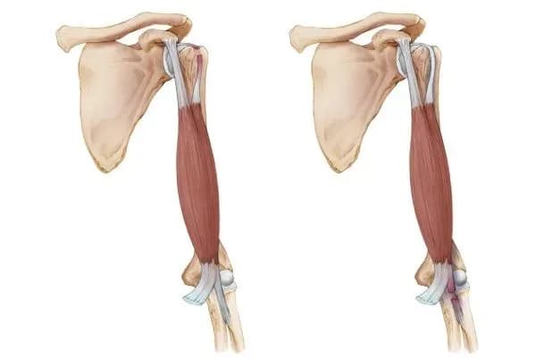 肱二头肌肌腱病变：从病因到治疗的全面解析