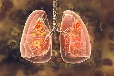 上海胸科医院陆舜团队：索卡佐利单抗联合疗法显著延长广泛期小细胞肺癌患者生存期
