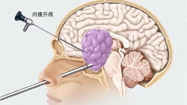 巨大垂体瘤致小伙暴瘦血糖飙升，华山医院“经鼻联合开颅”新技术根除祸根