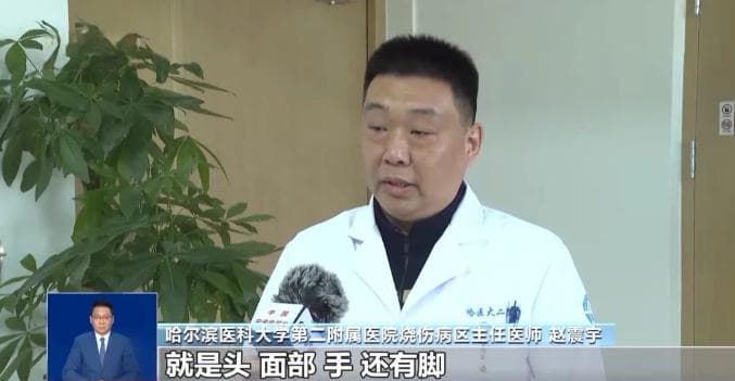 女子模仿“泼水成冰”被烫伤，专家提醒：水温需90℃以上