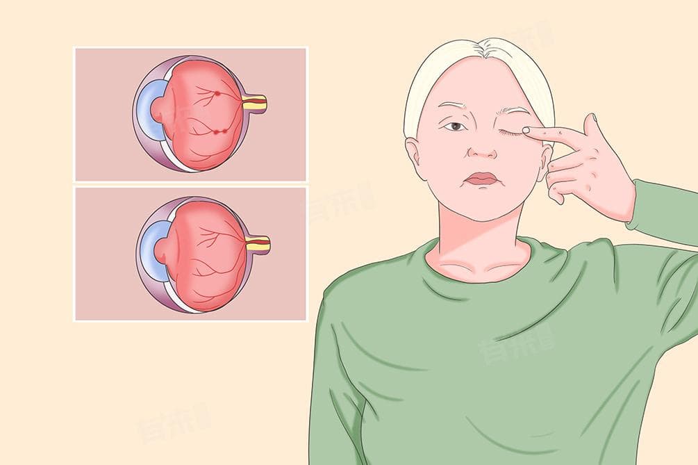 糖尿病引起眼睛的并发症