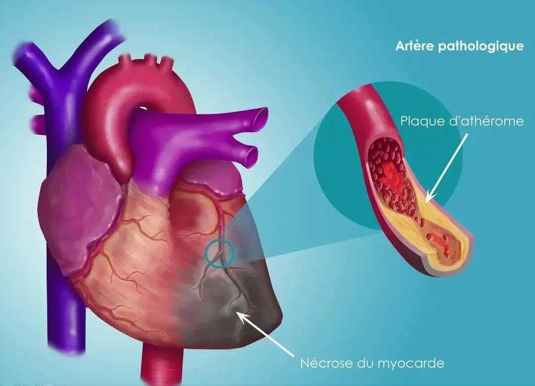 用药探究：治疗冠心病心绞痛等心血管疾病的5个中成药