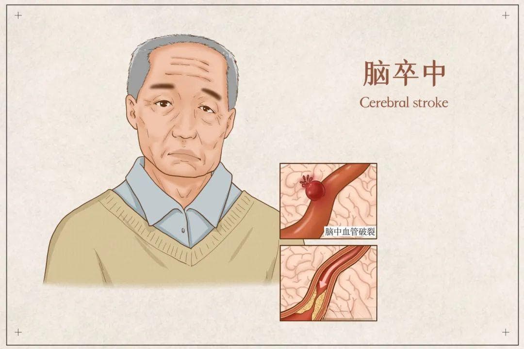 脑卒中又到高发期！牢记口诀可救命