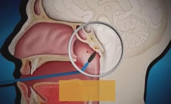 鼻塞、鼻出血、嗅觉失灵，这些常见症状可能暗藏哪些疾病？