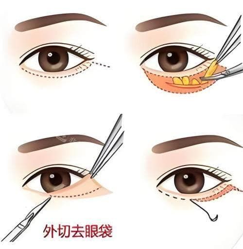 内切法、外切法：去眼袋手术如何选择？