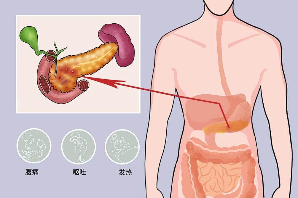 远离急性胰腺炎：饮食调整与体检筛查双管齐下