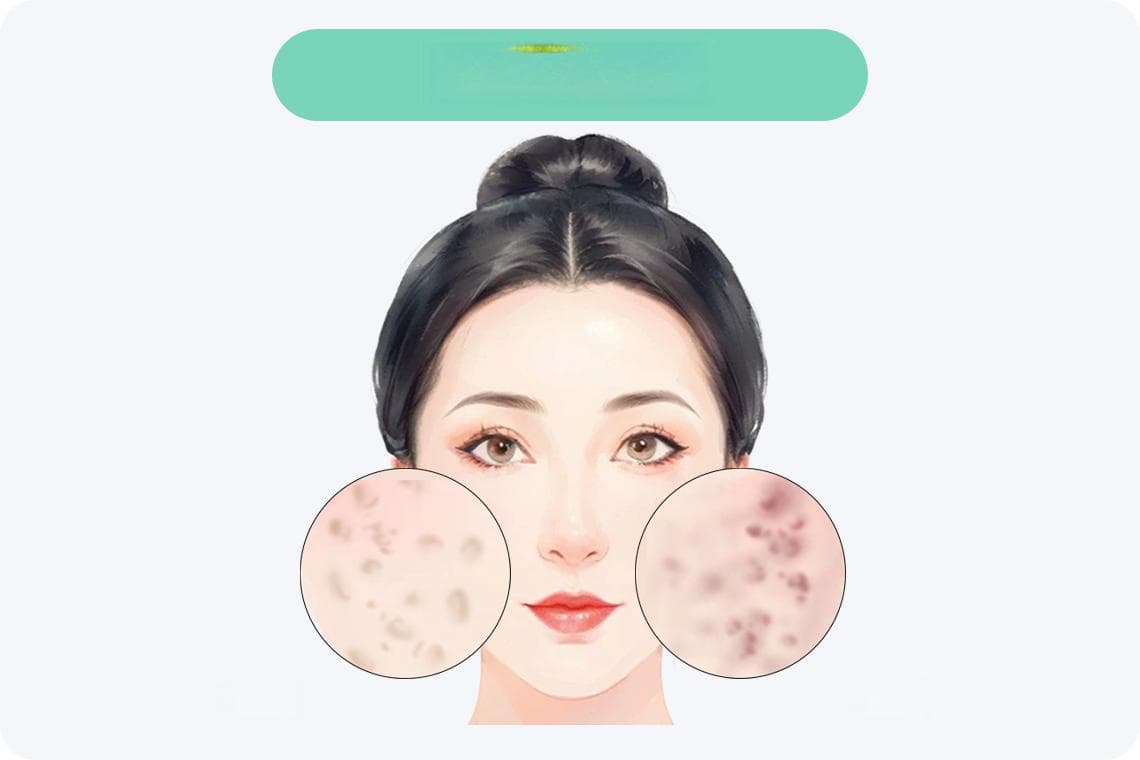 脸上很多痘印痘坑怎么去除