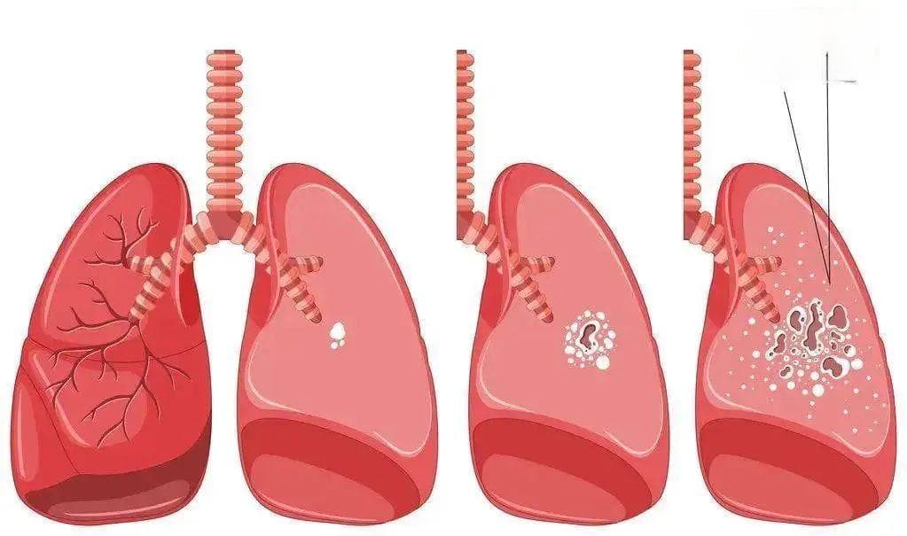 病理技术——病理科如何诊断结核病？哪种方法最有效？