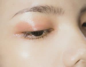 痘肌护理：有效的治疗方案与日常管理