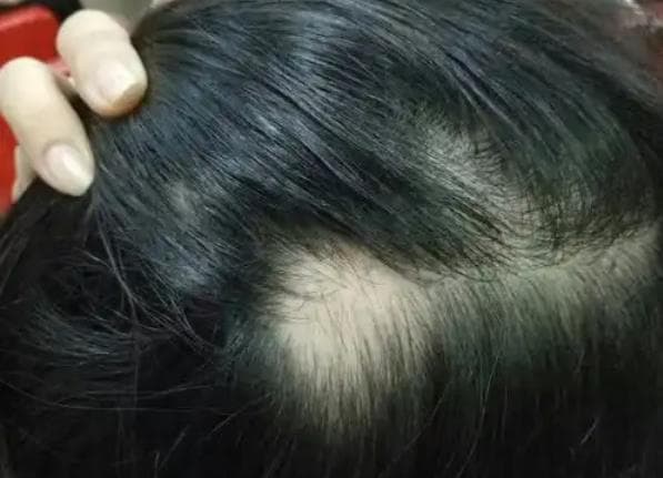 从1个月到6个月：斑秃治疗效果显现时间表
